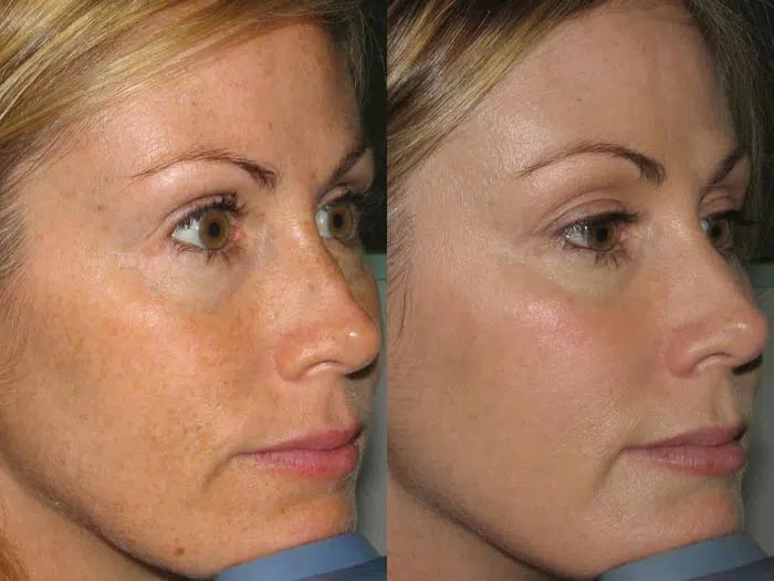 Photorejuvenation before and after photo by Medispa Maui and Wellness Center in Kihei, HI