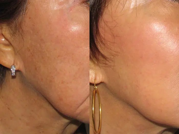 Photorejuvenation before and after photo by Medispa Maui and Wellness Center in Kihei, HI