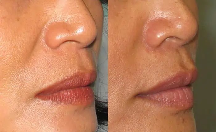 Dermal Fillers before and after photo by Medispa Maui and Wellness Center in Kihei, HI