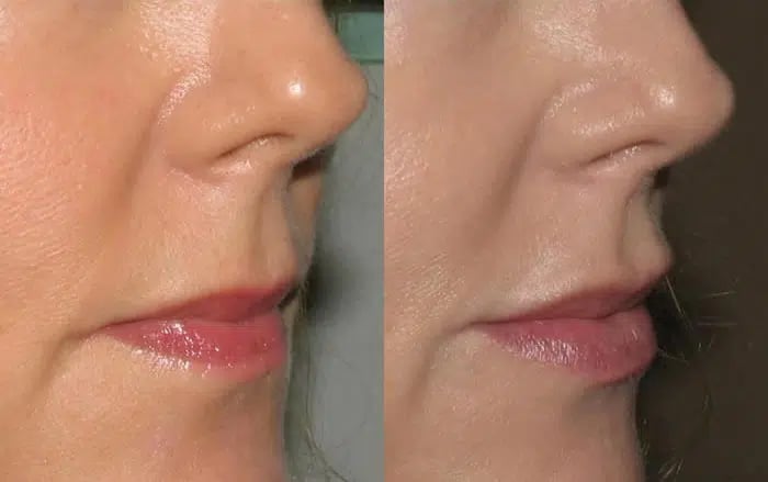 Dermal Fillers before and after photo by Medispa Maui and Wellness Center in Kihei, HI