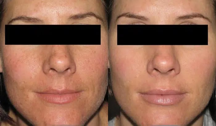 Dermal Fillers before and after photo by Medispa Maui and Wellness Center in Kihei, HI