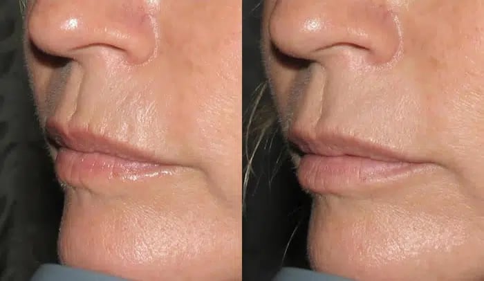 Dermal Fillers before and after photo by Medispa Maui and Wellness Center in Kihei, HI