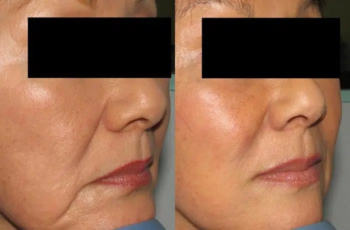 Dermal Fillers before and after photo by Medispa Maui and Wellness Center in Kihei, HI