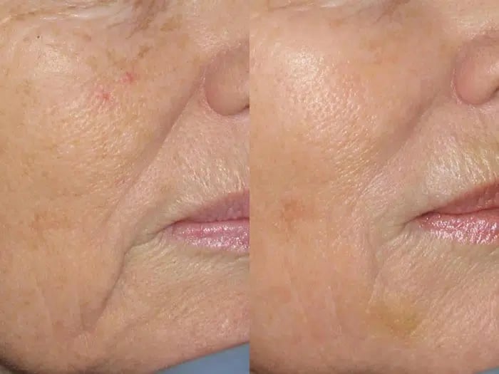 Dermal Fillers before and after photo by Medispa Maui and Wellness Center in Kihei, HI