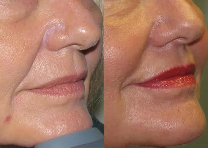 Dermal Fillers before and after photo by Medispa Maui and Wellness Center in Kihei, HI