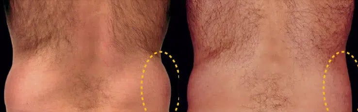 CoolSculpting before and after photo by Medispa Maui and Wellness Center in Kihei, HI CoolSculpting before and after photo by Medispa Maui and Wellness Center in Kihei, HI