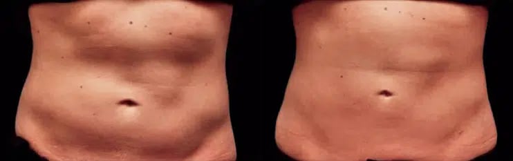 CoolSculpting before and after photo by Medispa Maui and Wellness Center in Kihei, HI CoolSculpting before and after photo by Medispa Maui and Wellness Center in Kihei, HI