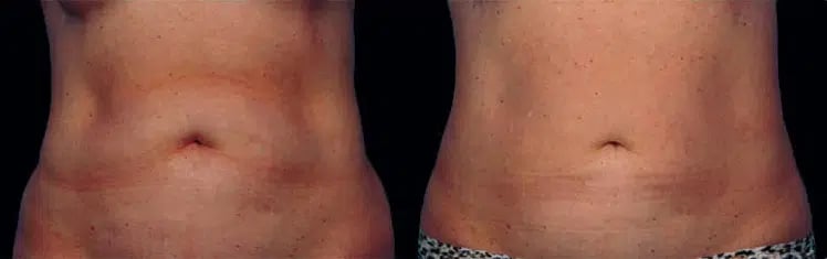 CoolSculpting before and after photo by Medispa Maui and Wellness Center in Kihei, HI CoolSculpting before and after photo by Medispa Maui and Wellness Center in Kihei, HI