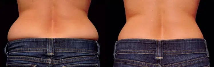 CoolSculpting before and after photo by Medispa Maui and Wellness Center in Kihei, HI CoolSculpting before and after photo by Medispa Maui and Wellness Center in Kihei, HI