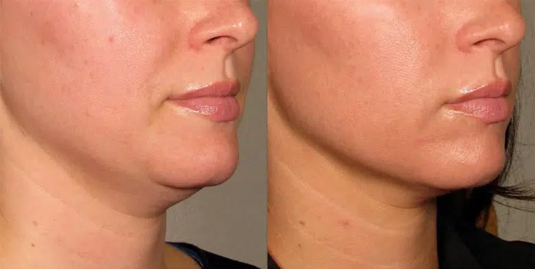 Ultherapy before and after photo by Medispa Maui and Wellness Center in Kihei, HI Ultherapy before and after photo by Medispa Maui and Wellness Center in Kihei, HI