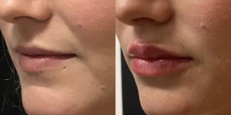 Dermal Fillers before and after photo by Medispa Maui and Wellness Center in Kihei, HI