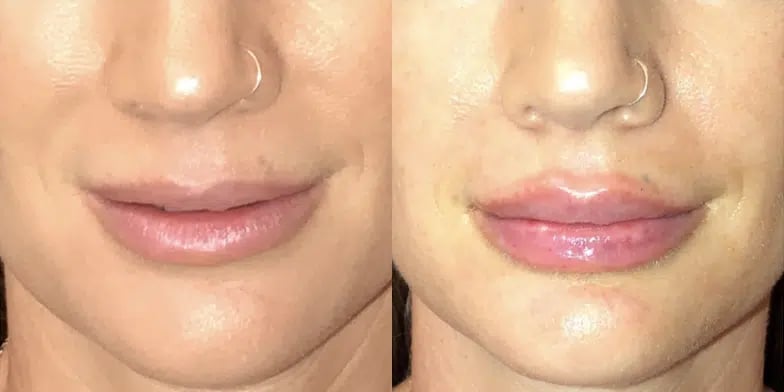 Dermal Fillers before and after photo by Medispa Maui and Wellness Center in Kihei, HI