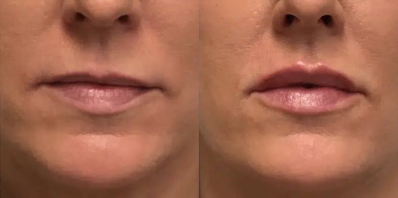 Dermal Fillers before and after photo by Medispa Maui and Wellness Center in Kihei, HI