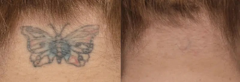 PicoSure before and after photo by Medispa Maui and Wellness Center in Kihei, HI PicoSure before and after photo by Medispa Maui and Wellness Center in Kihei, HI