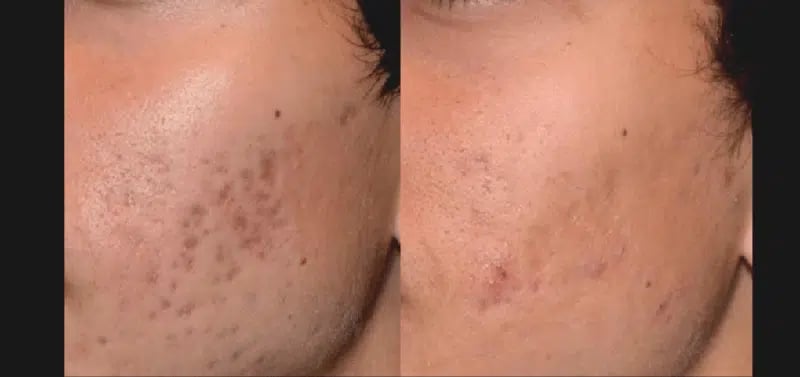 PicoSure Acne treatment before and after photo by Medispa Maui and Wellness Center in Kihei, HI PicoSure Acne treatment before and after photo by Medispa Maui and Wellness Center in Kihei, HI